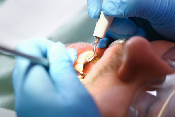 Best Emergency Dentist for Lost Fillings or Crowns in Blue Ridge, TX
